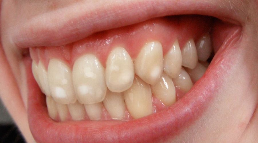 What Are The White Spots On My Teeth? A Kelowna Dentist Explains
